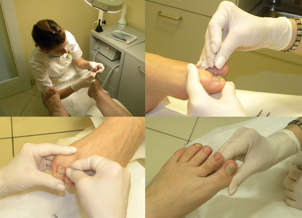 VHO kopča - postavljanje