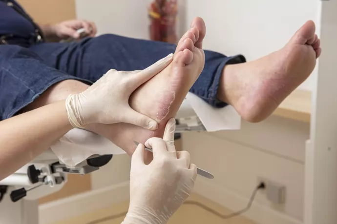 Što je nakupina zadebljale kože (hyperkeratoza)?