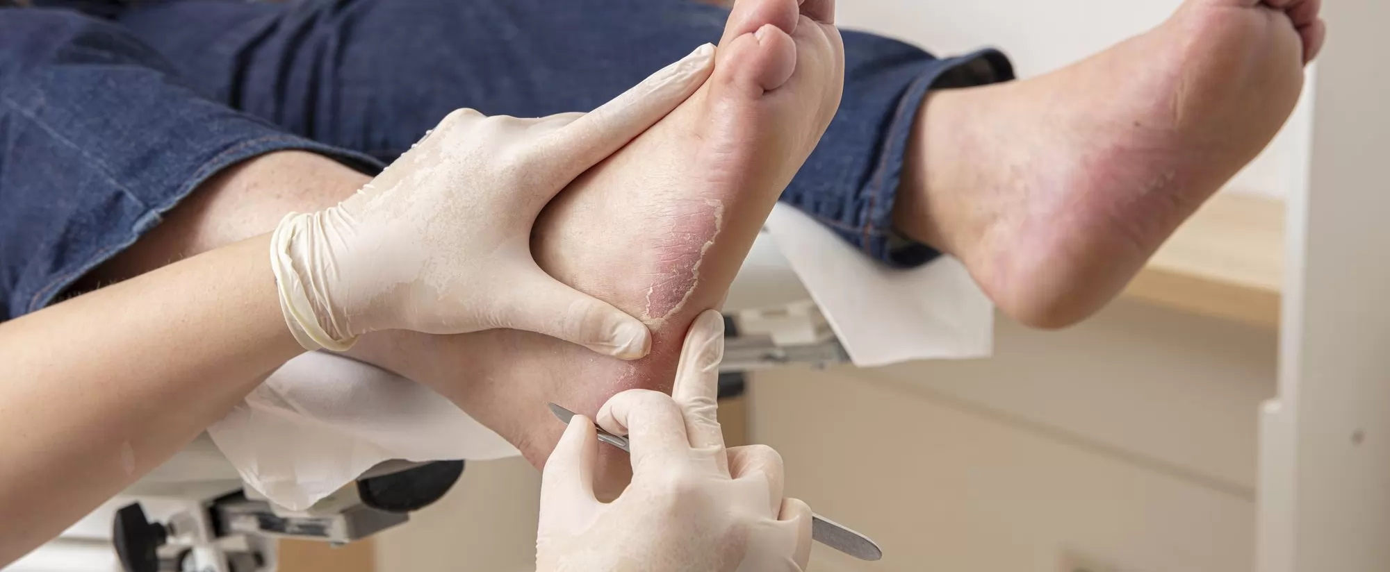 Što je nakupina zadebljale kože (hyperkeratoza)?