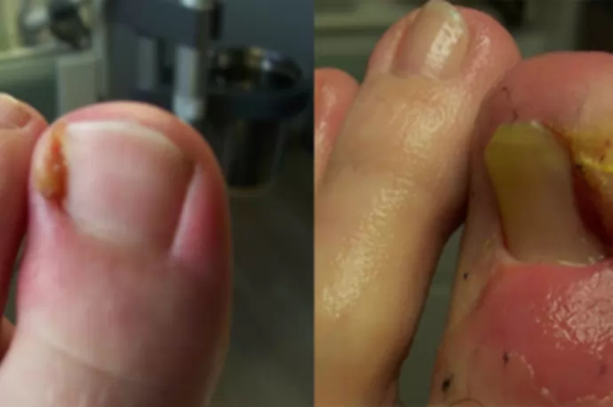 Što je urasli nokat?