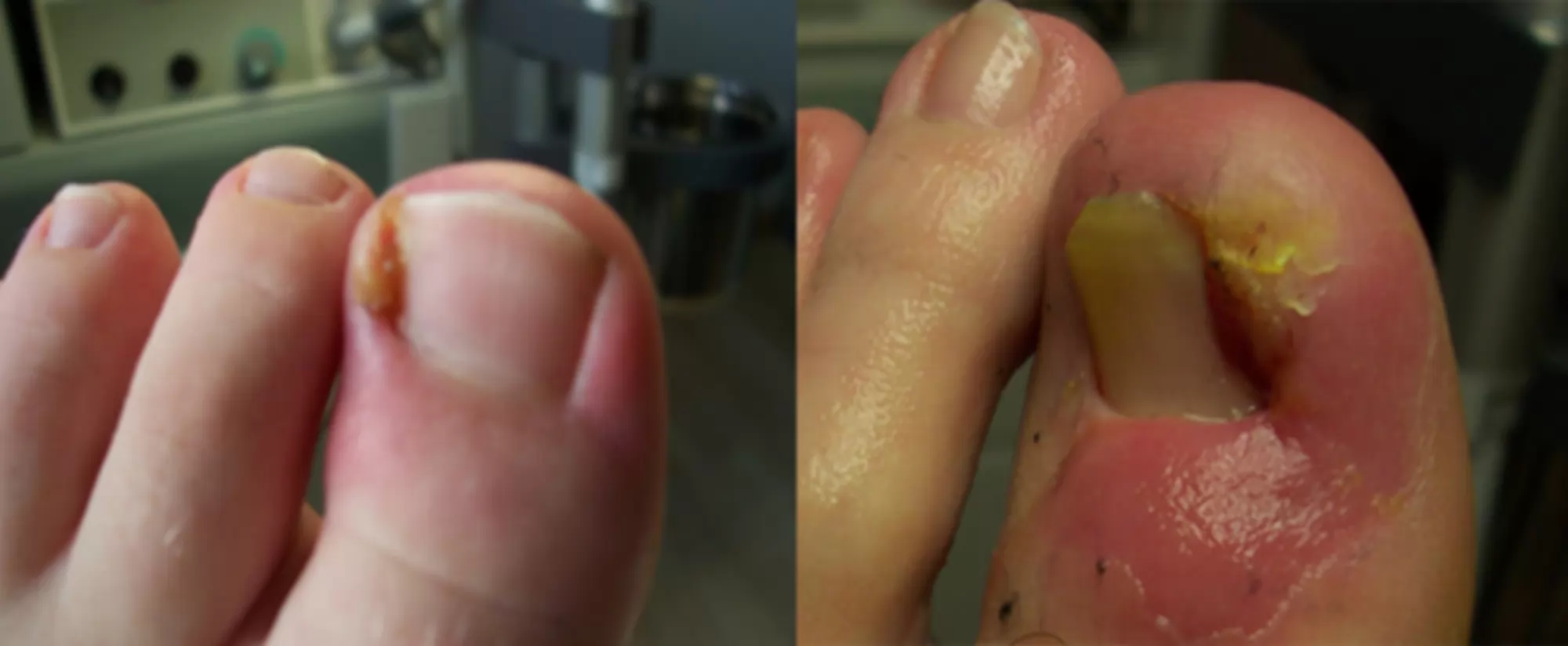 Što je urasli nokat?