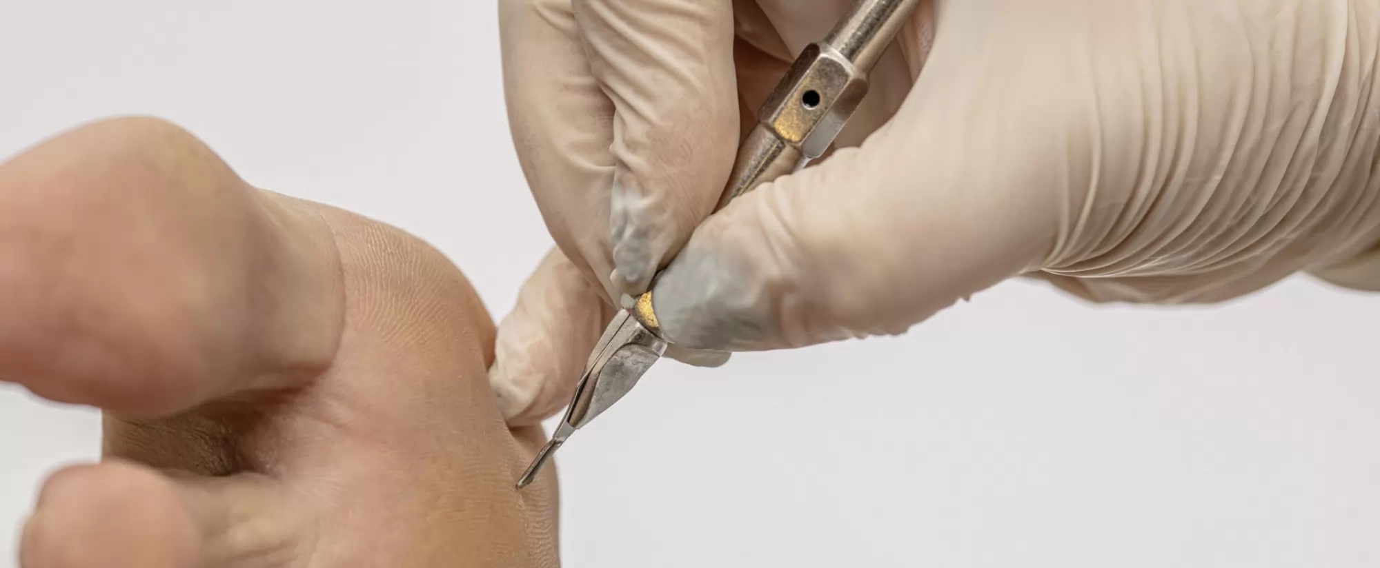 Tehnike obrade dijabetičkog stopala